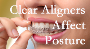 Clear aligners influence posture which Groton chiropractic helps.