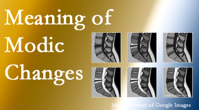 Shoreline Medical Services/ Hutter Chiropractic Office sees many back pain and neck pain patients who bring their MRIs with them to the office. Modic changes are often noted. 