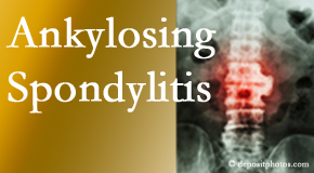 Ankylosing spondylitis is gently cared for by your Groton chiropractor.