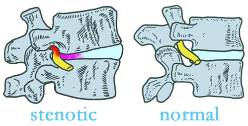 Groton stenotic and normal spinal discs