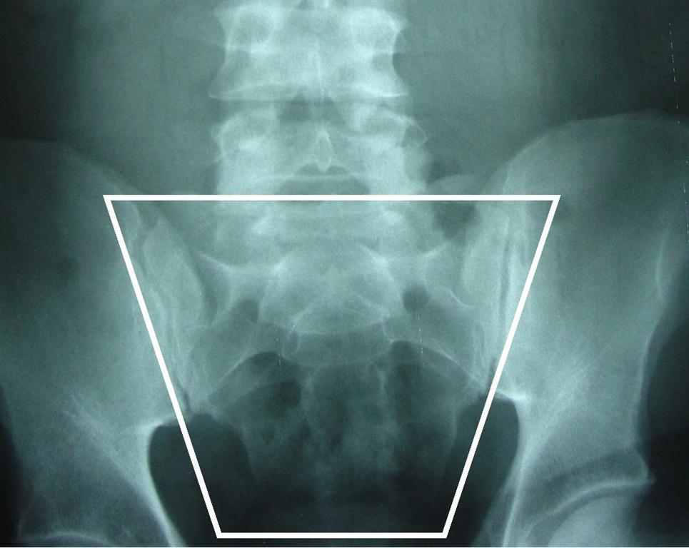 sacrum
