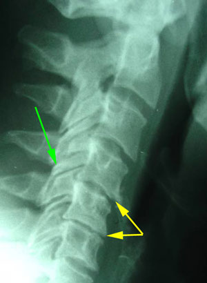disc degeneration treated at Shoreline Medical Services/ Hutter Chiropractic Office
