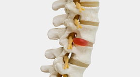 Groton chiropractic conservative care helps even giant disc herniations go away