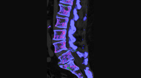 Shoreline Medical Services/ Hutter Chiropractic Office is aware that inflammatory spinal gout is a differential diagnosis to consider for patients who present with back pain and other spine related symptoms.