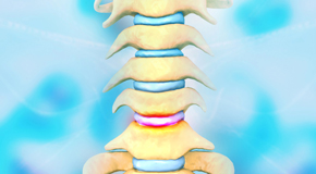 Groton disc degeneration health