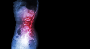 Groton Chiropractic Care of Spondylolisthesis 