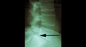 Groton spondylolisthesis 