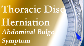 Shoreline Medical Services/ Hutter Chiropractic Office treats thoracic disc herniation that for some patients prompts abdominal pain.