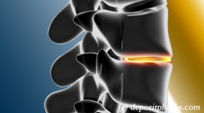 Groton degenerative spinal changes 