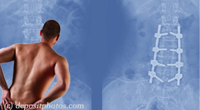 Groton chiropractic relief for back pain after back surgery