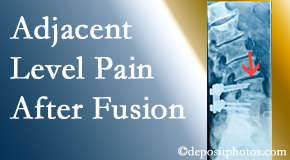 Shoreline Medical Services/ Hutter Chiropractic Office offers relieving care non-surgically to back pain patients suffering with adjacent level pain after spinal fusion surgery.