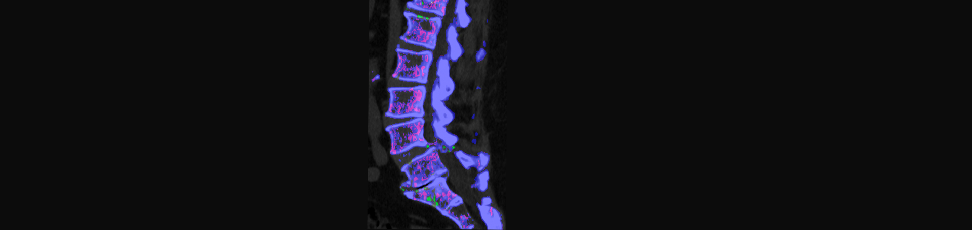 Shoreline Medical Services/ Hutter Chiropractic Office is aware that inflammatory spinal gout is a differential diagnosis to consider for patients who present with back pain and other spine related symptoms.
