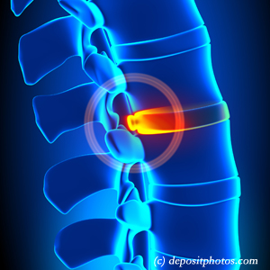 picture of lumbar Groton disc herniation