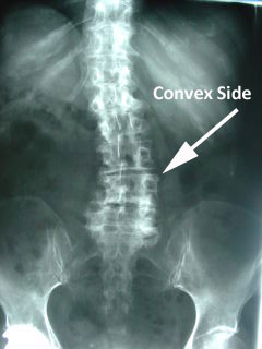 convex side of scoliotic curve